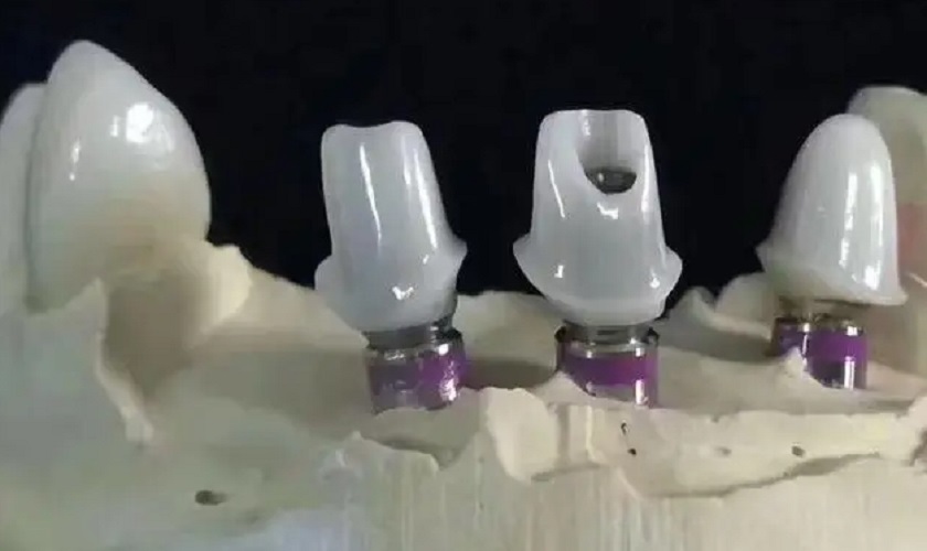 Phục hình Implant cho người có quai hàm lớn