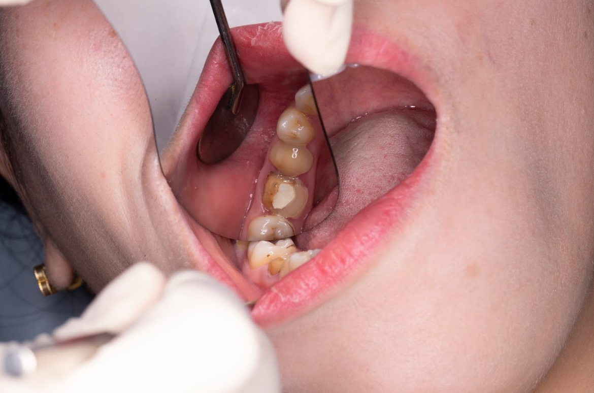 Cầu răng hỏng 3 lần không thể bảo tồn bệnh nhân phải chuyển sang trồng Implant