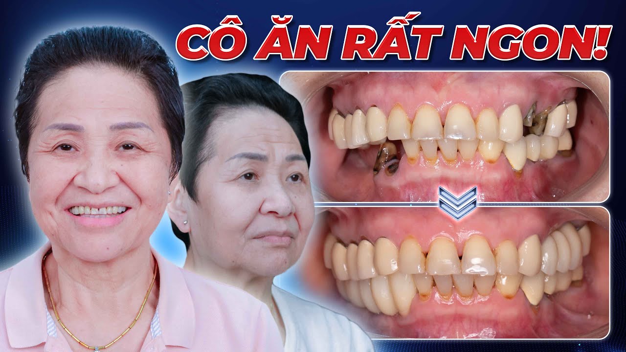 Kết quả trước và sau trồng răng của cô Hoàng Thị Phương