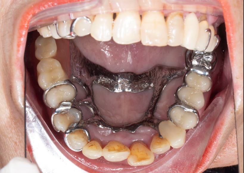 Hình ảnh bên trong hàm đeo hàm tháo lắp đã điều trị Implant tại Nha khoa Olympia