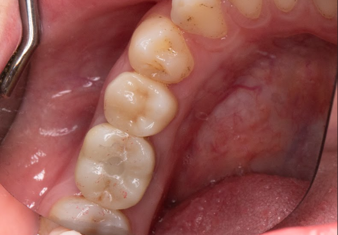 Kết quả sau trồng răng Implant của KH Nguyễn Thị Cẩm Vân