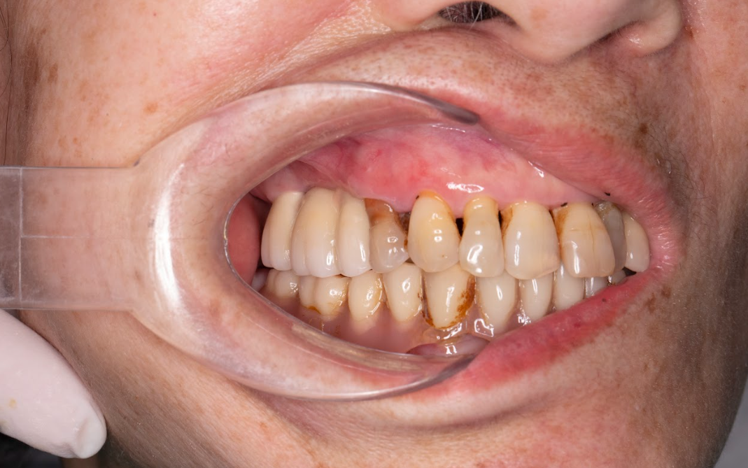 Lắp răng bên phải hoàn thiện của cô Dương Thị Cúc