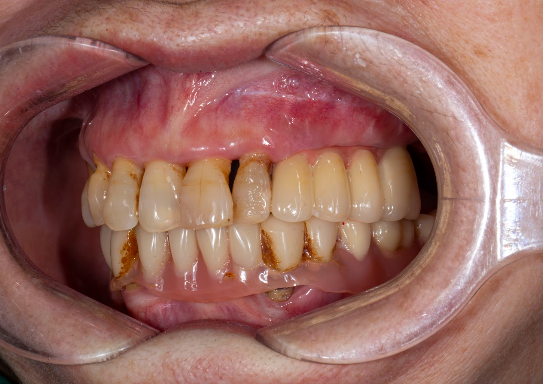 Lắp răng bên trái hoàn thiện của cô Dương Thị Cúc