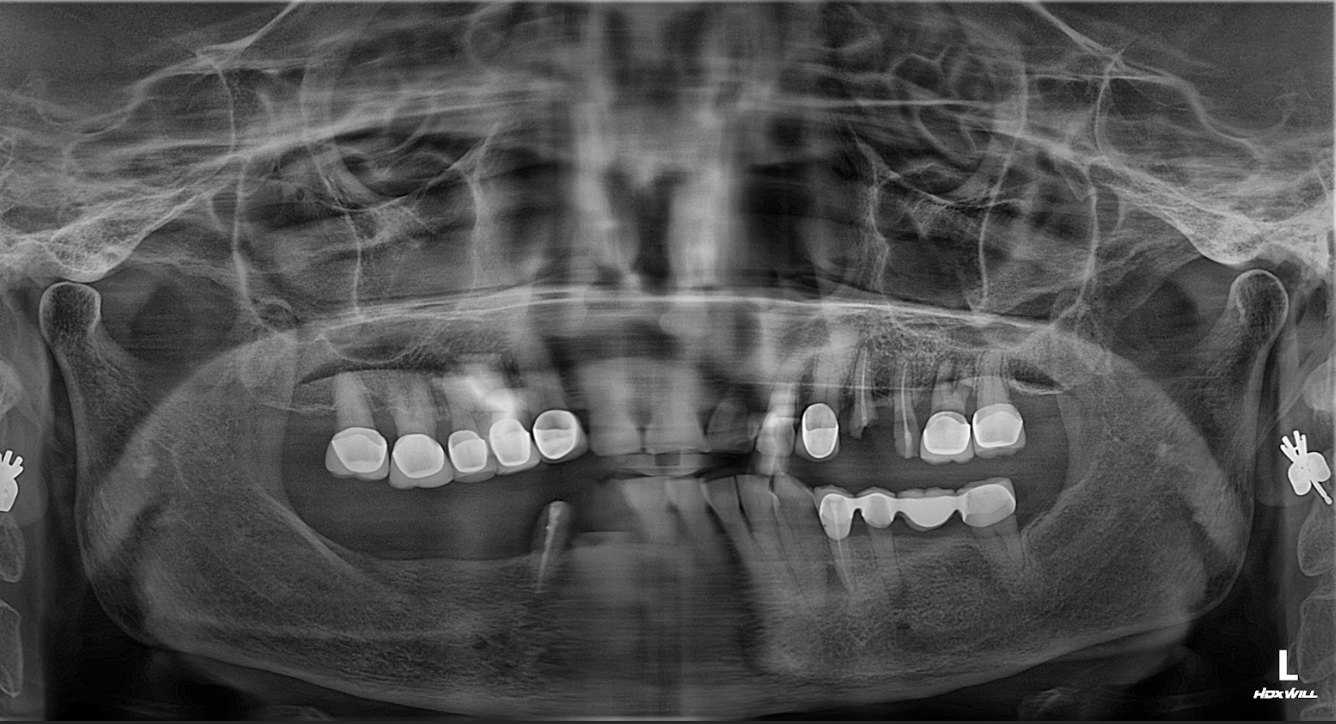 Tình trạng mất răng ban đầu của cô Hoàng Thị Phương