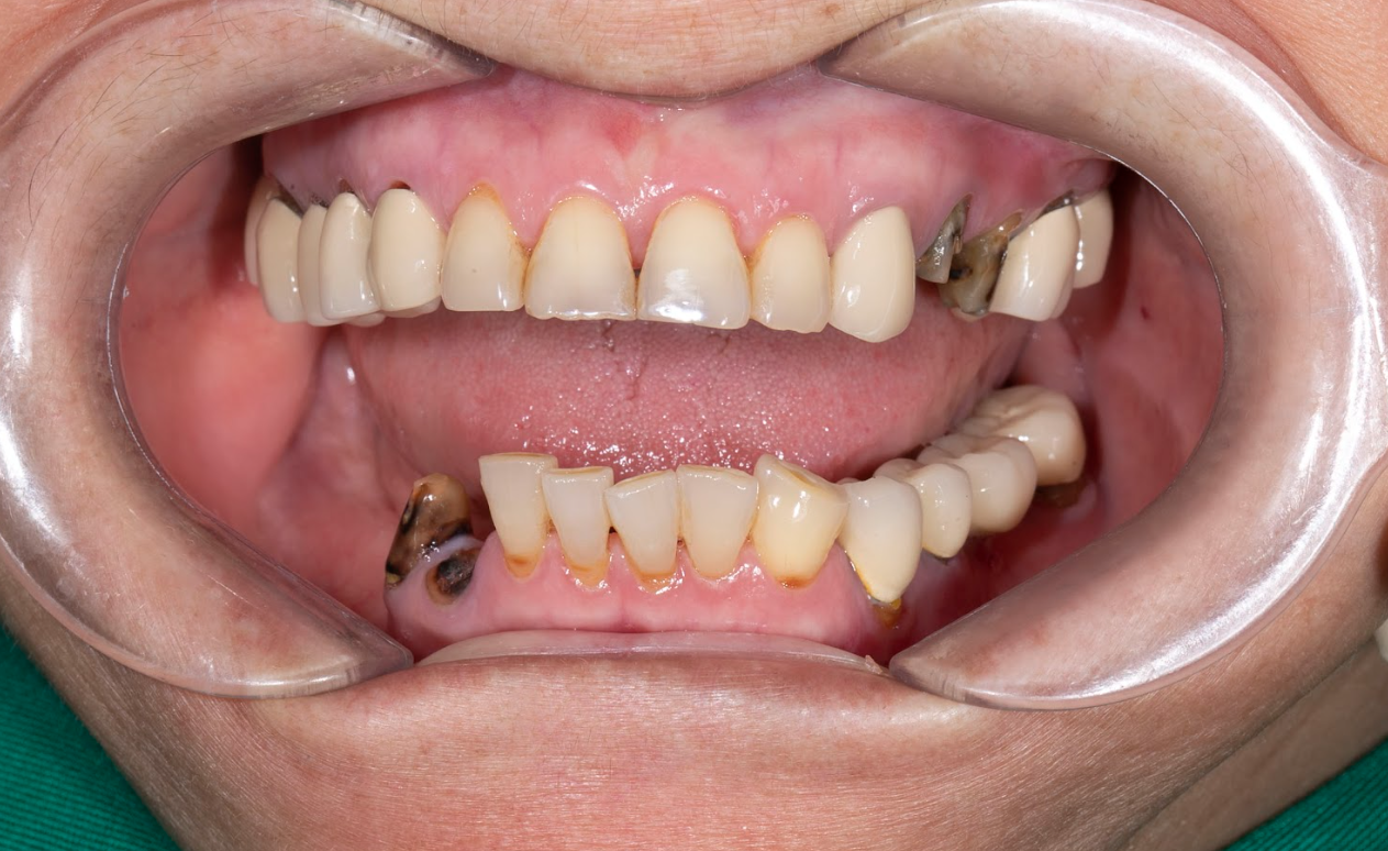 Tình trạng mất răng ban đầu trong miệng của cô Hoàng Thị Phương