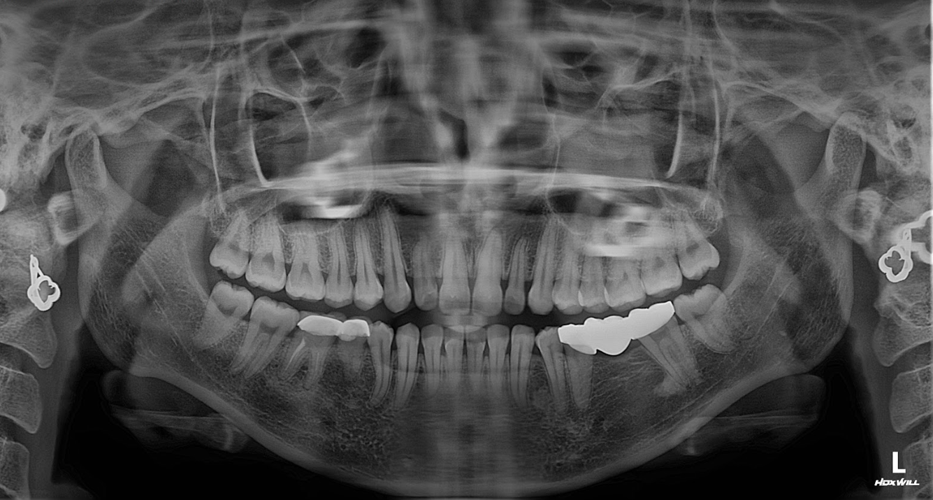 Phim X-Quang trước khi làm răng Implant
