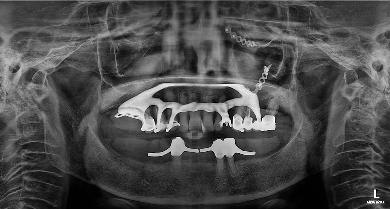 Phim X-Quang trước khi trồng răng của cô Cúc