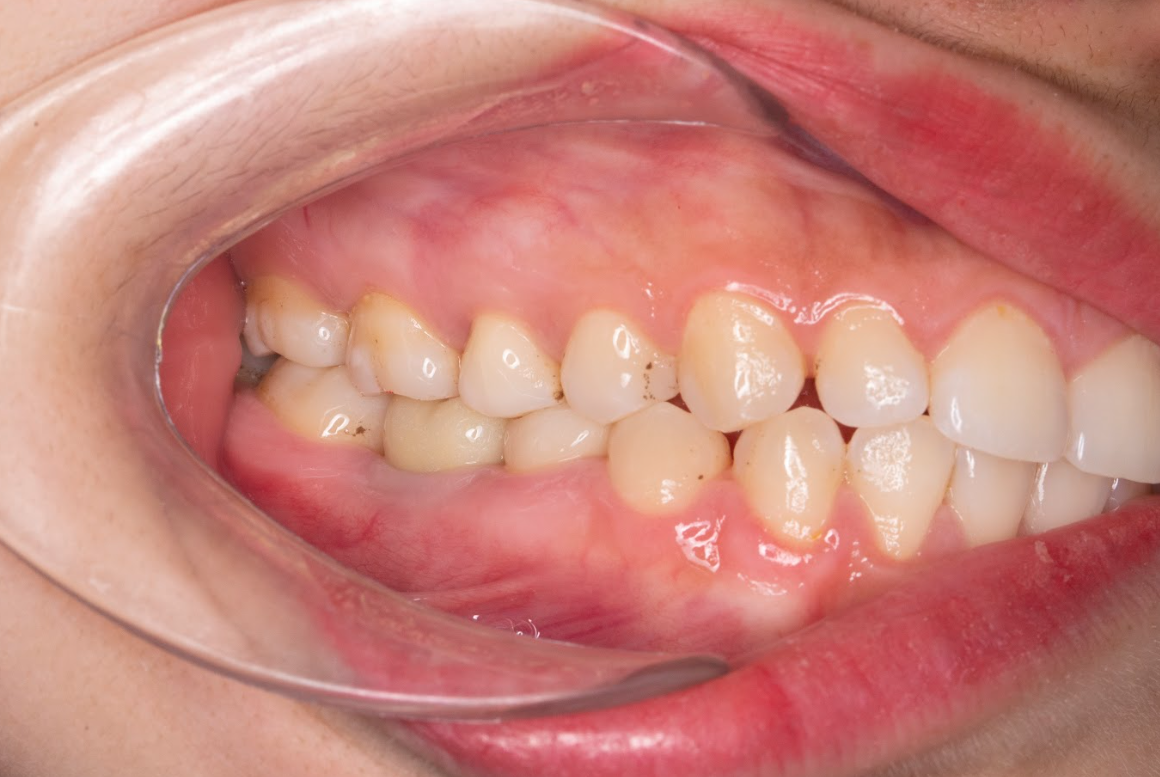 Sau 3 tháng trồng răng của KH Nguyễn Thị Cẩm Vân (SN 1997, Hưng Yên(