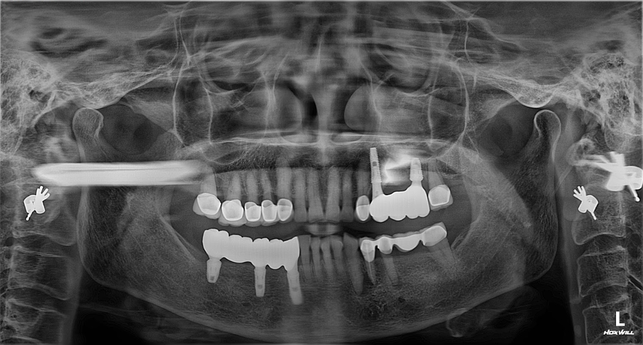 Hình ảnh chụp phim toàn cảnh