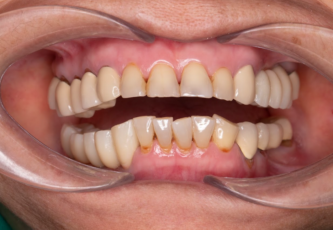 Kết quả sau trồng răng của cô Hoàng Thị Phương trên miệng