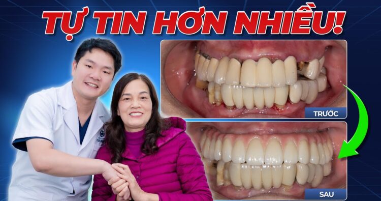 trồng răng Implant toàn hàm cùng bác sĩ bùi văn hưng