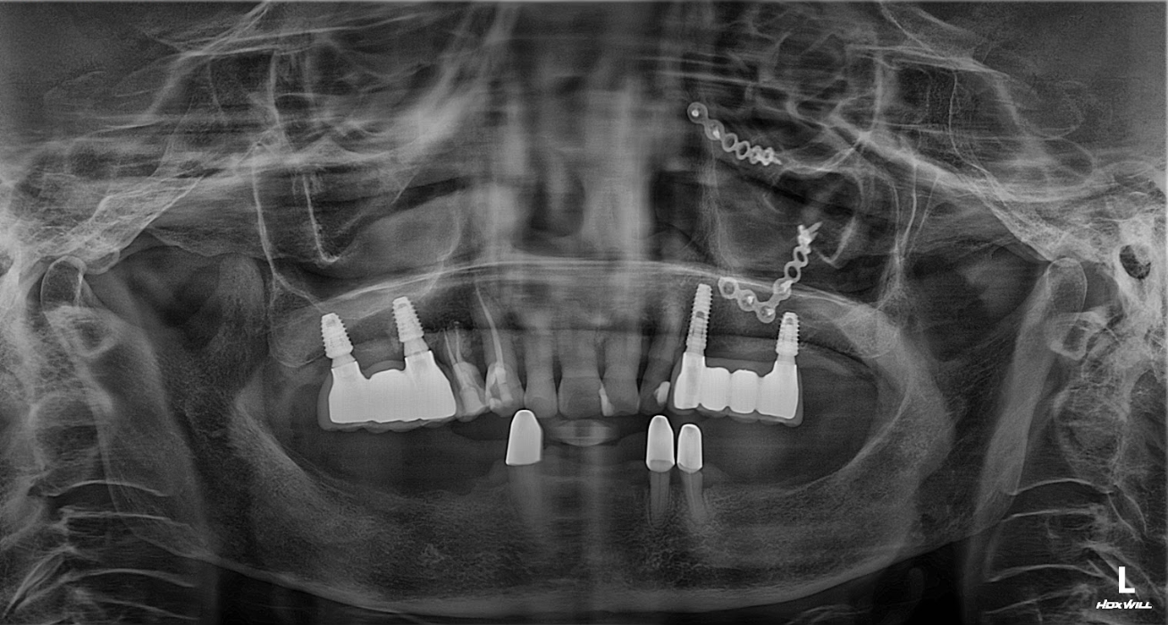Hình ảnh phim X-quang lắp răng hoàn thiện của cô Cúc
