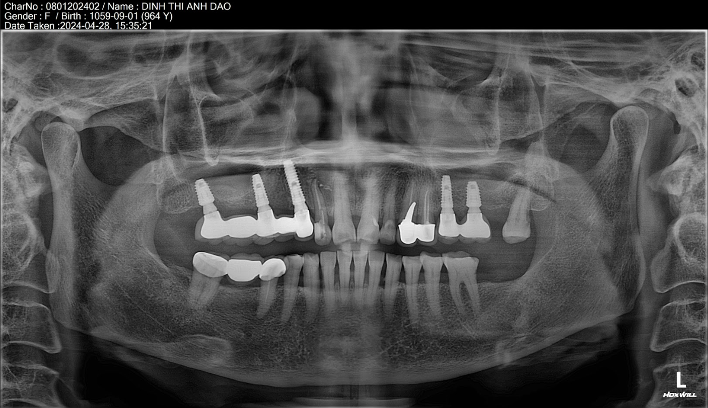 Mấy 5 răng liên tiếp trồng 3 trụ Implant