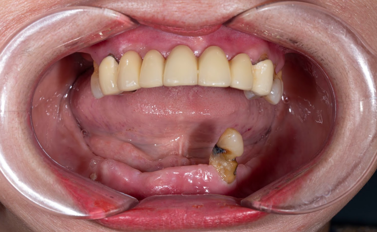 Dùng hàm tháo lắp lâu năm khiến răng 1 khách hàng bị tiêu hết xương, phải trồng toàn hàm