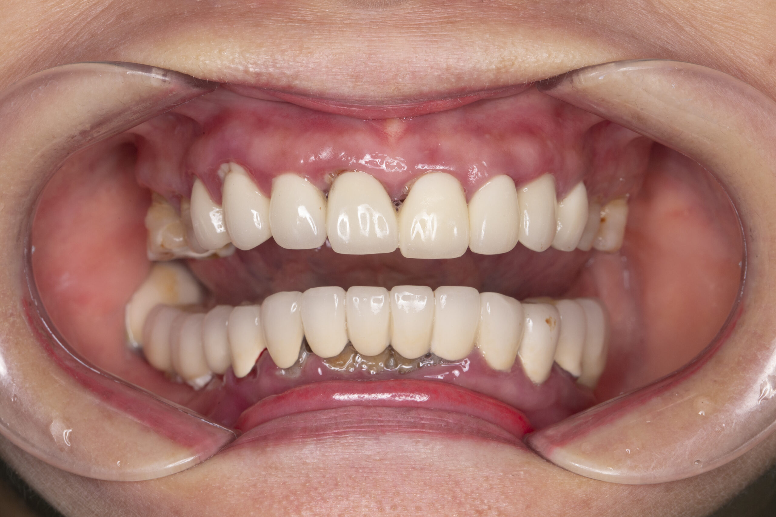 Trường hợp mất răng của cô Nguyễn Kim Hoa (64 tuổi; Hoàn Kiếm- Hà Nội); Trồng Implant toàn hàm dưới