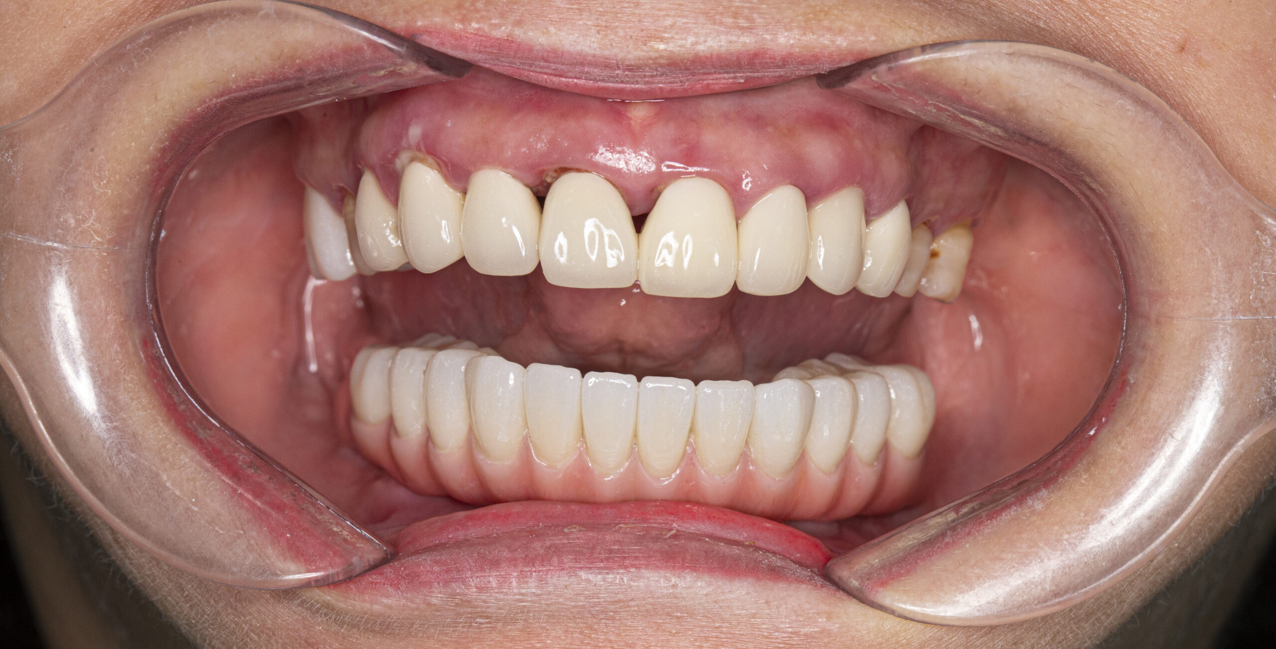 Kết quả trồng răng toàn hàm dưới của cô Hoa sau 2 tháng