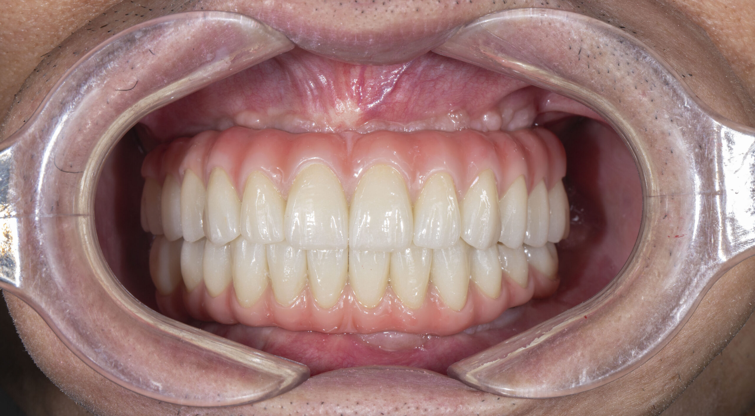 Kết quả sau trồng răng toàn 2 hàm của chú Hợp