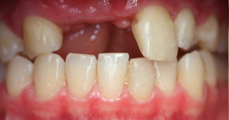 Mất 2 răng cửa hàm trên liên tiếp
