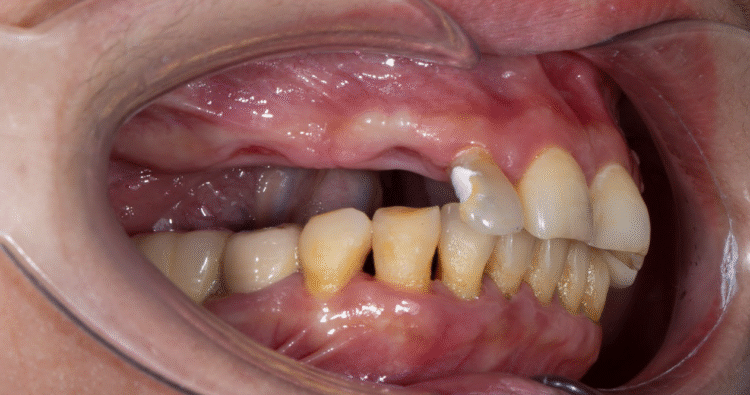 Mất răng 5 liên tiếp cần trồng 3-4 trụ, làm 5 răng lên trên