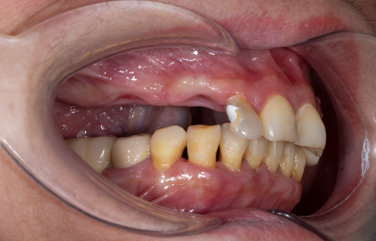 Mất răng 5 liên tiếp cần trồng 3-4 trụ, làm 5 răng lên trên