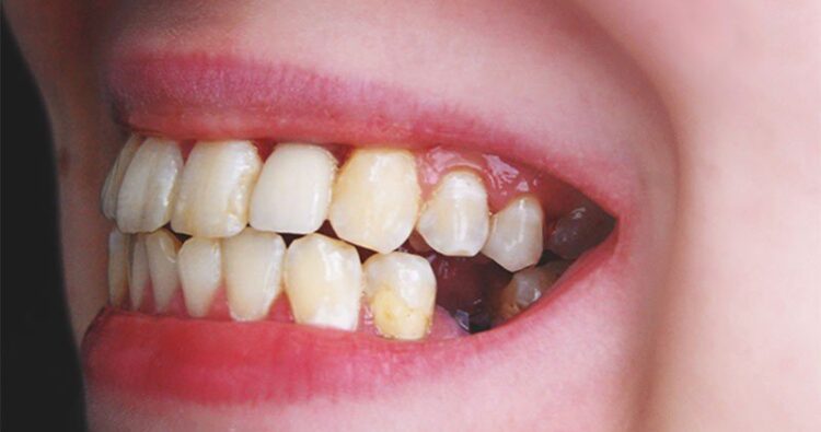 6 hệ quả nghiêm trọng khi mất răng số 6 mà không phục hồi sớm