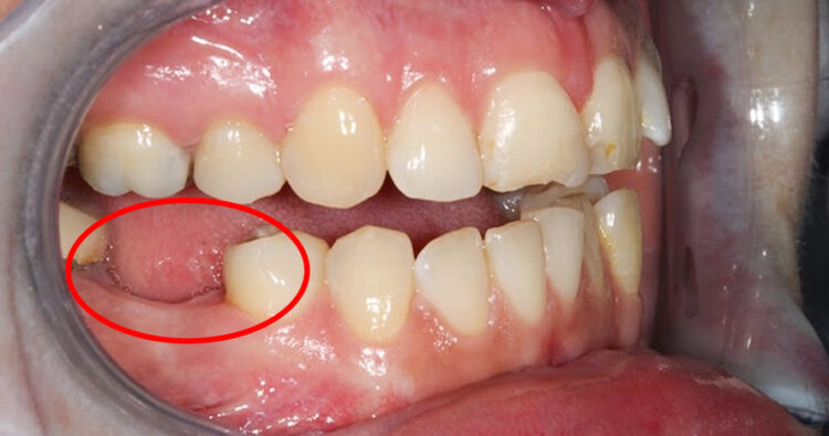 Trường hợp mới mất răng nền xương và khoảng còn tốt