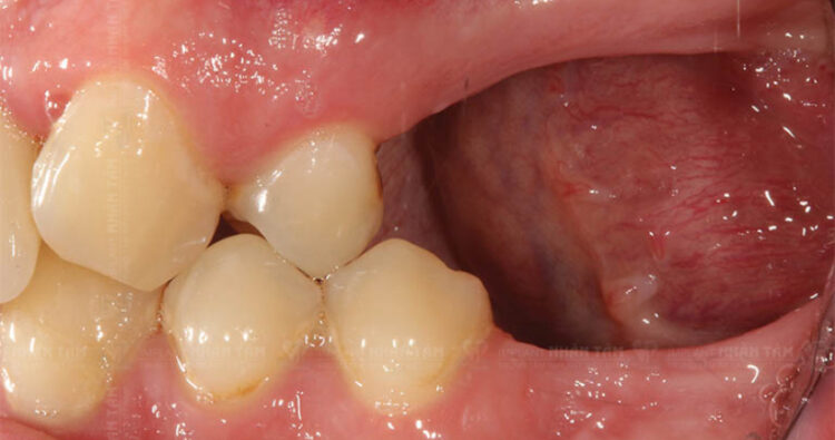 Mất răng 6 và 7 liền kề nhau