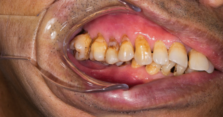 Răng kế cận nghiêng/đổ, răng đối diện trồi — làm xô lệch cung hàm