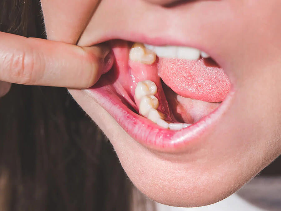 Người mất răng lâu năm thường bị tiêu xương tụt lợi