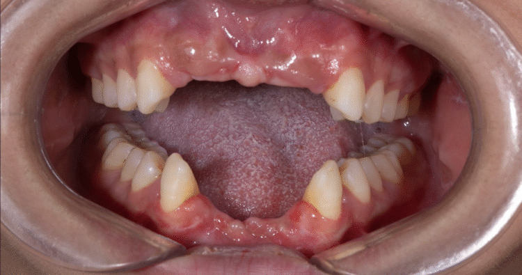 Mất răng cửa do tai nạn – vấn đề tưởng nhỏ nhưng hậu quả lớn