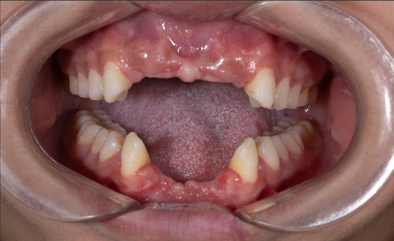 Mất răng cửa do tai nạn – vấn đề tưởng nhỏ nhưng hậu quả lớn