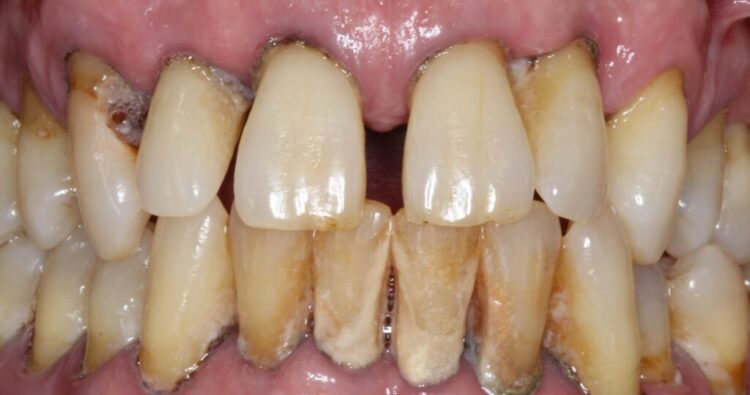 Răng lung lay có giữ được không