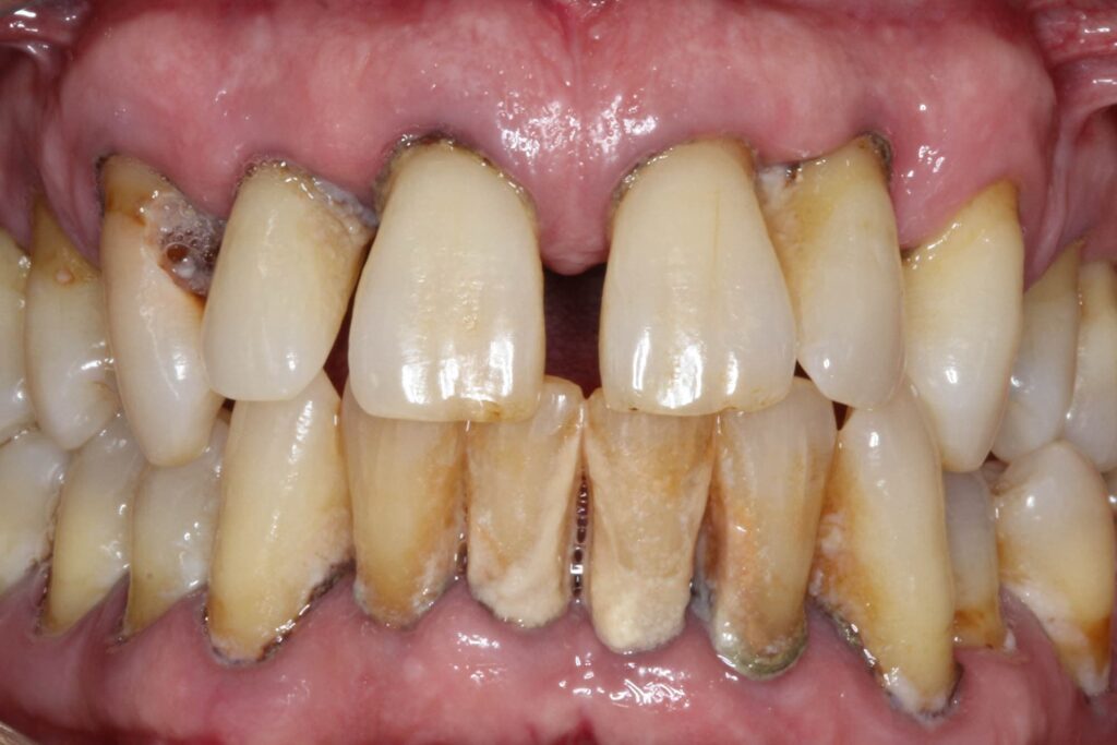 Răng lung lay có giữ được không