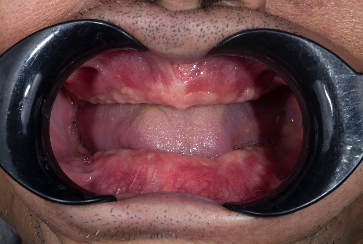 Chú Bùi Đình Hợp (66 tuổi; Việt Kiều Mỹ); Trồng Implant toàn 2 hàm