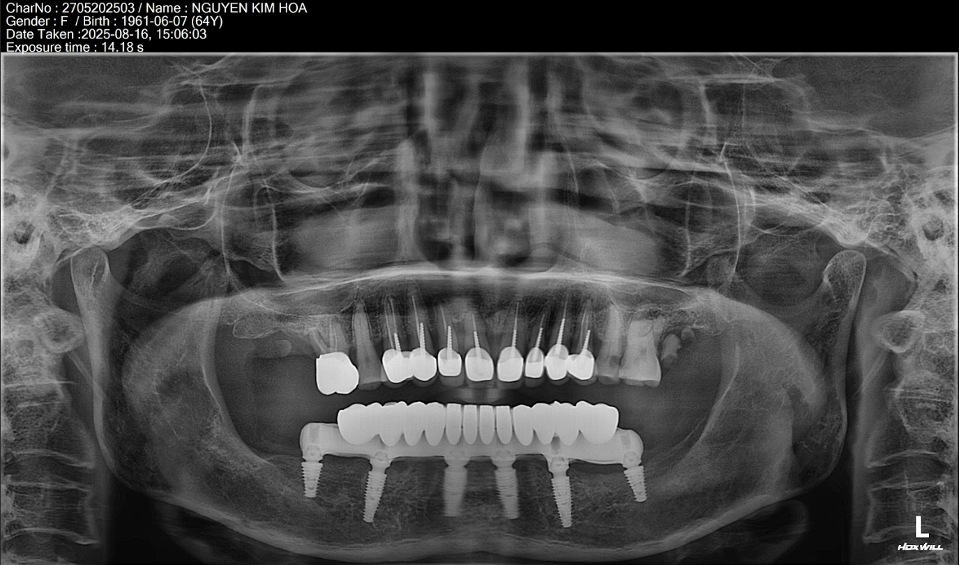 Kỹ thuật đặt trụ theo góc tối ưu giúp chịu lực tốt hơn