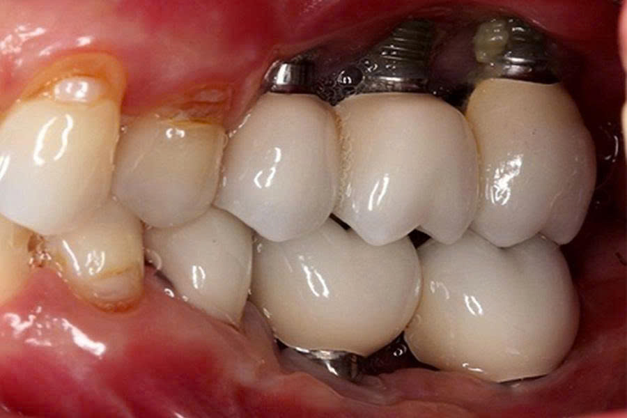 Trụ Implant trôi nổi không rõ nguồn gốc xuất xứ trên thị trường