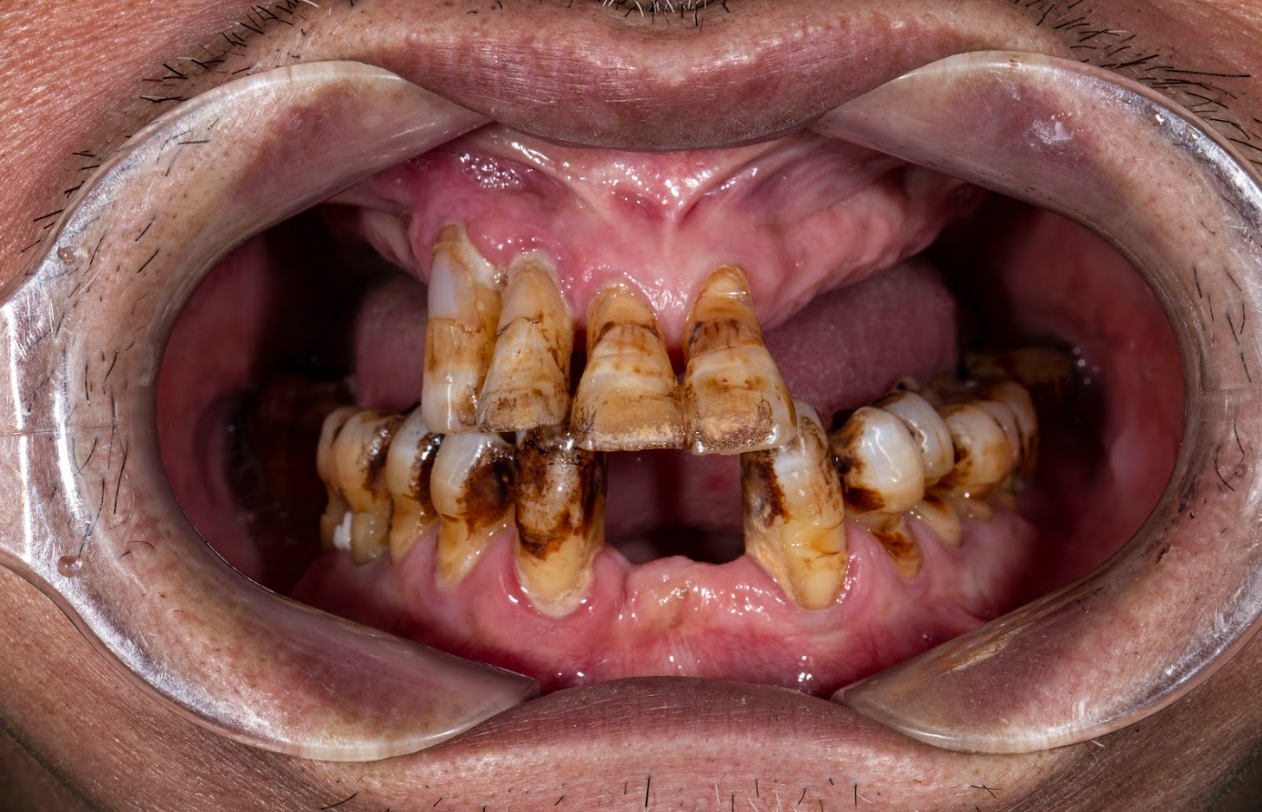 1 trường hợp răng phải trồng Implant toàn hàm