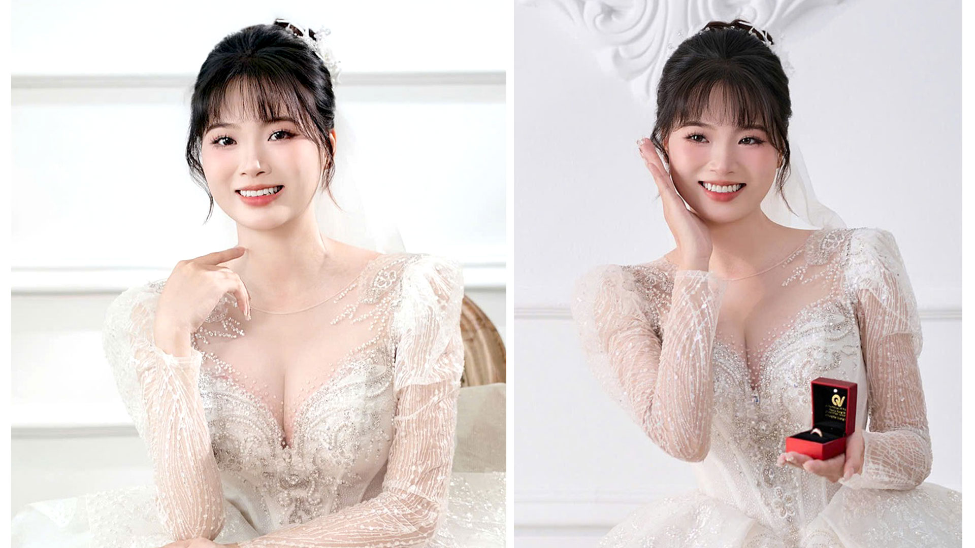 Kết quả trồng răng cửa của bạn Bùi Thị Phương sau 5 tháng