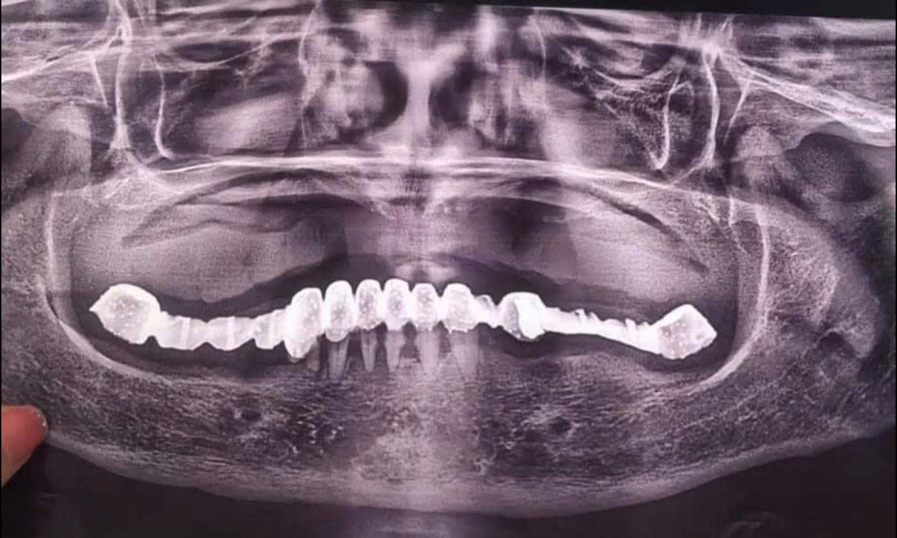 Cầu răng siêu dài vài răng gánh cả 1 hàm răng