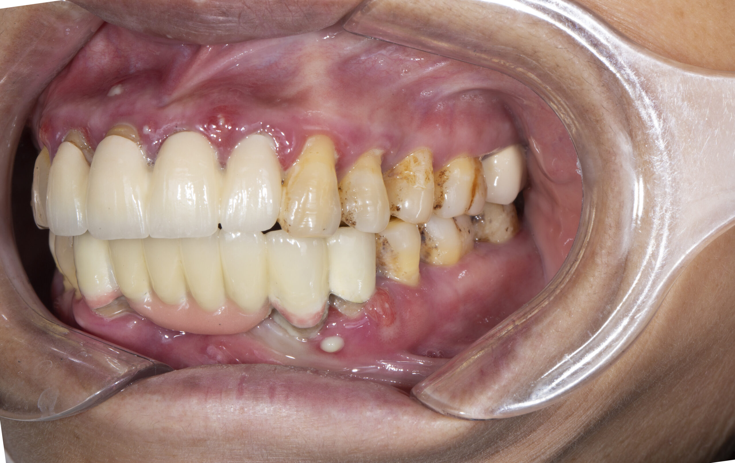 Viêm quanh răng – hôi miệng – tụt lợi