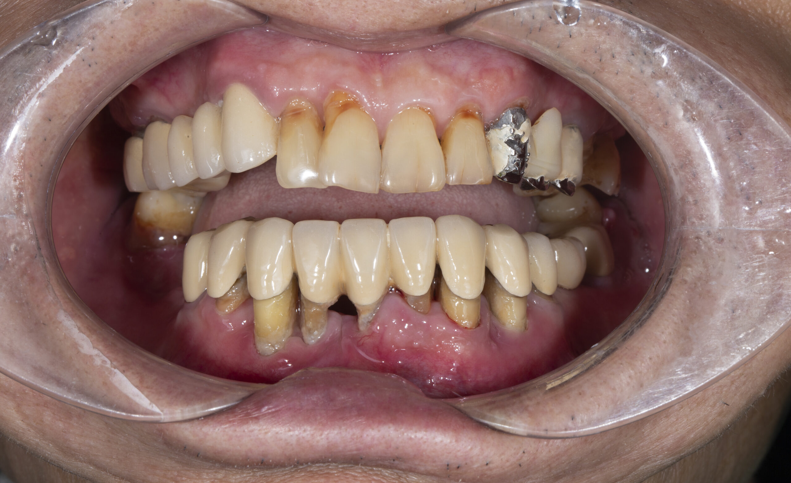 Cầu răng sứ siêu dài khi hỏng kéo theo hệ lụy hỏng hàng loạt răng