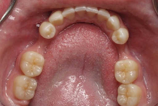 Mất 2 Răng Đơn Lẻ (Không Liền Nhau)