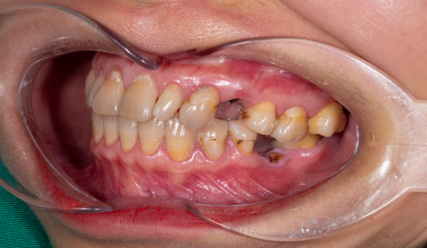 Mất 2 Răng Đơn Lẻ (Không Liền Nhau)