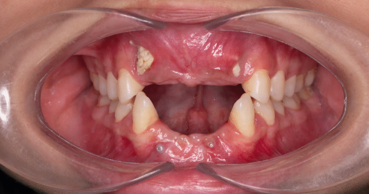 Mất 4 răng cửa do tai nạn mạnh