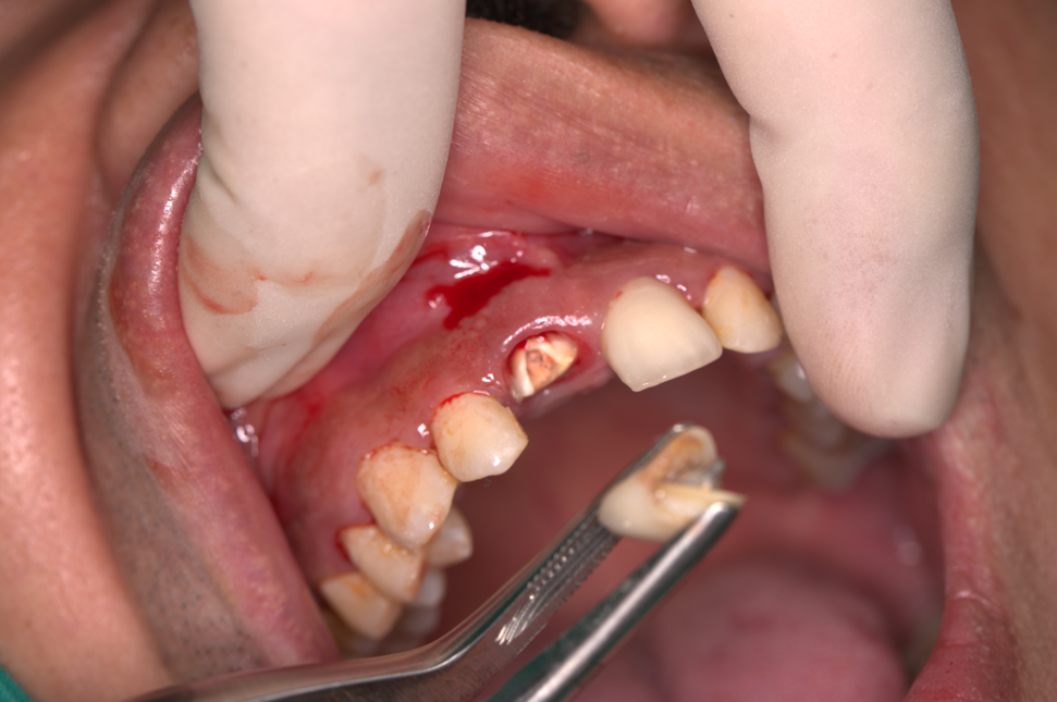 Mất răng cửa do va chạm/ nhai phải đồ cứng