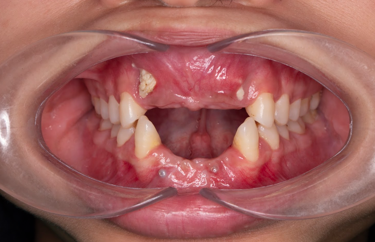 Răng cửa là vùng xương và lợi mỏng nhất trong cung hàm