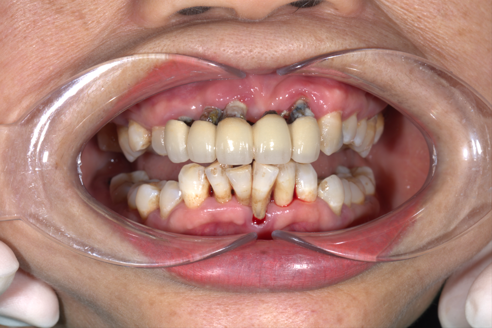 Răng trụ bị mài nhỏ → yếu dần theo thời gian