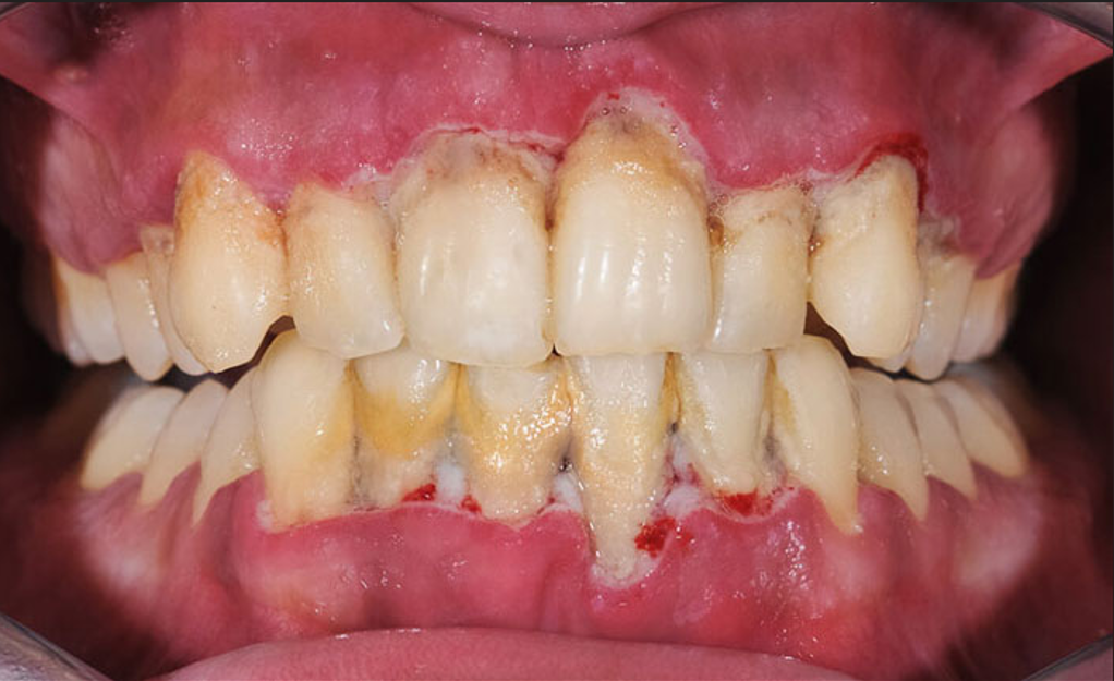 Viêm quanh răng có apxe quanh răng, sưng nề mặt, sốt nhẹ trong đợt cấp