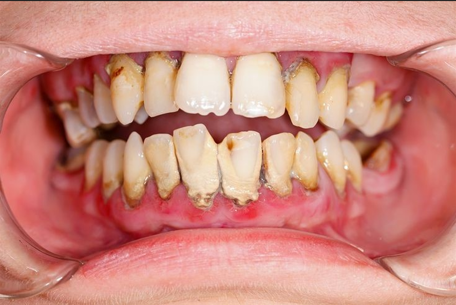 Dấu hiệu viêm quanh răng mà người trung – cao tuổi