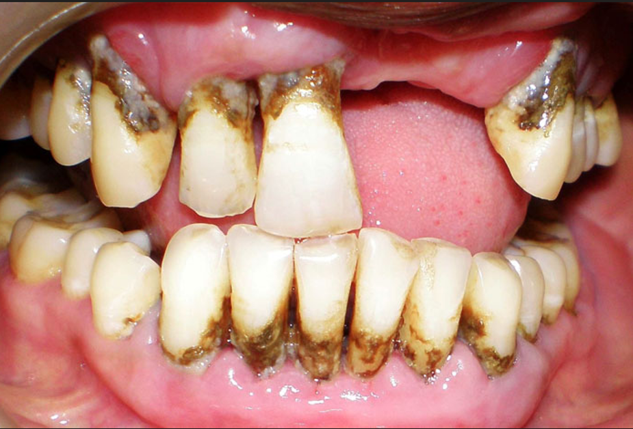 Giai đoạn tiến triển (viêm quanh răng nhẹ → trung bình)